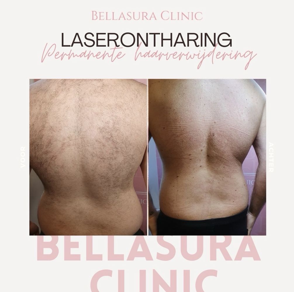 Laser ontharen rug, voor en na de behandelingen bij Bellasura Clinic