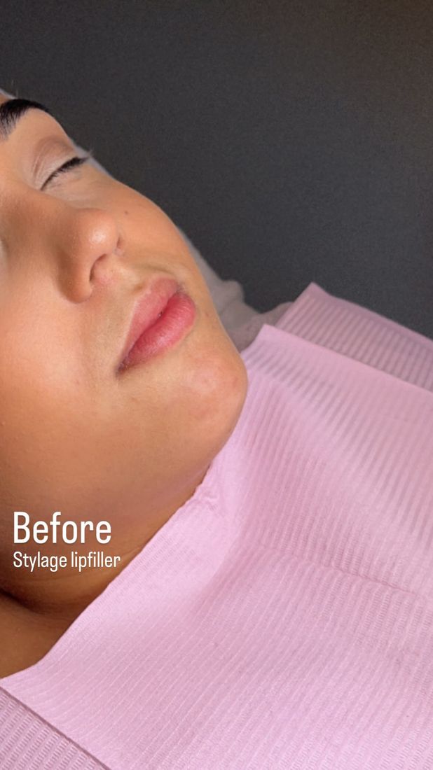 Lip filler: voor, Bellasura Clinic Sliedrecht